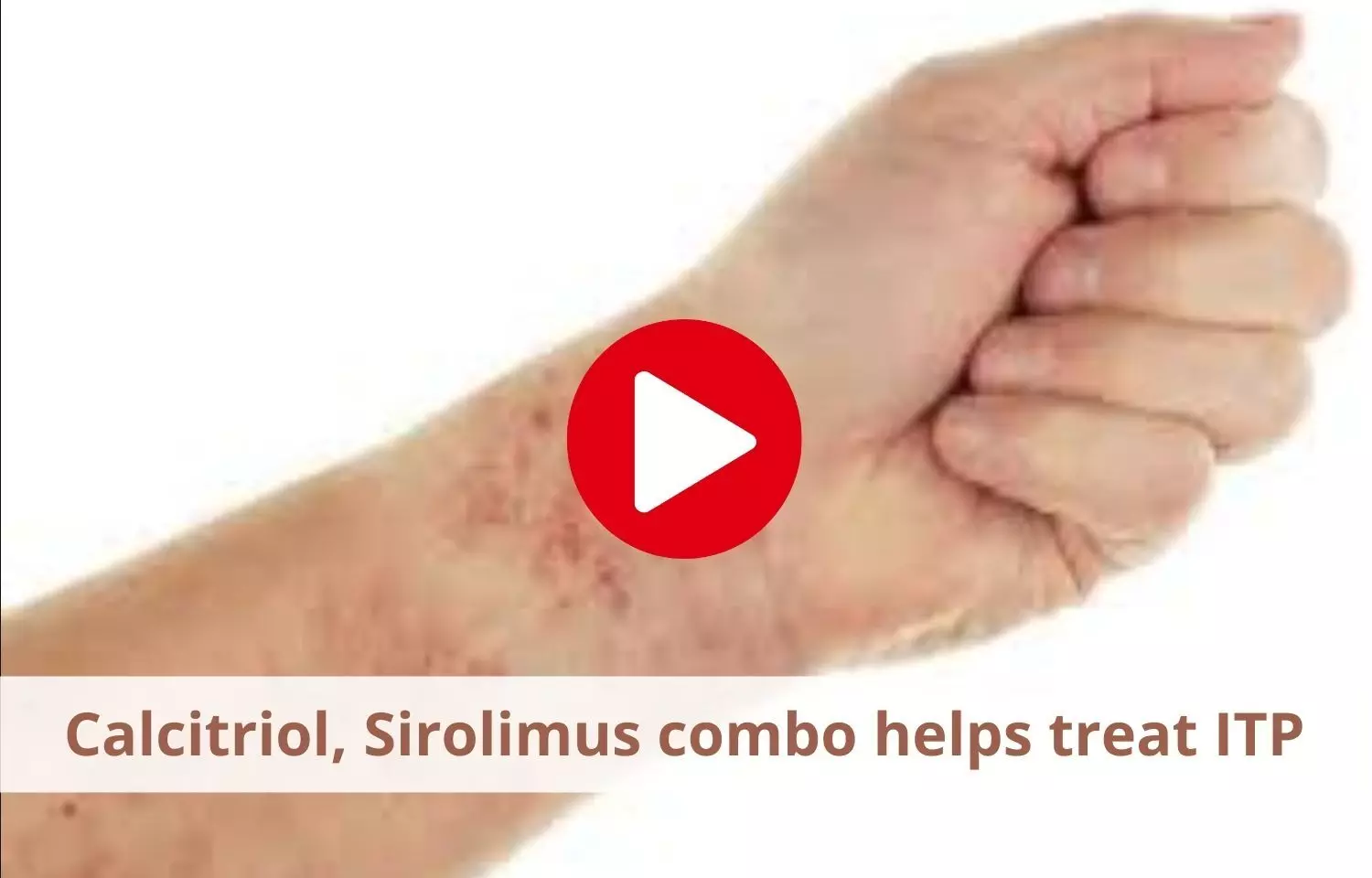 Calcitriol, Sirolimus combination efficacious in treating immune thrombocytopenia