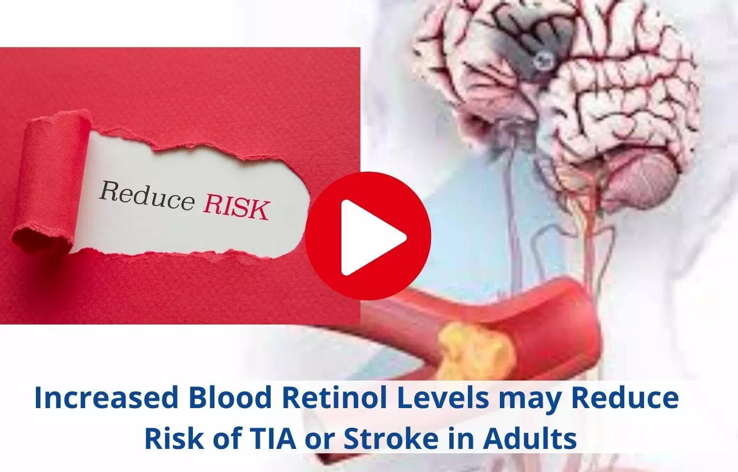 High blood retinol levels decreases the risk of TIA, Stroke