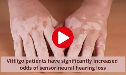 Patients with vitiligo at high risk of sensorineural hearing loss