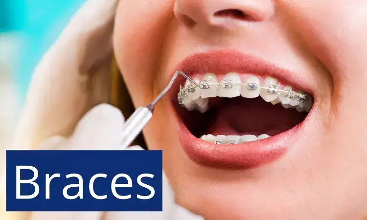 Your A-Z Guide to Invisible Braces for Teeth