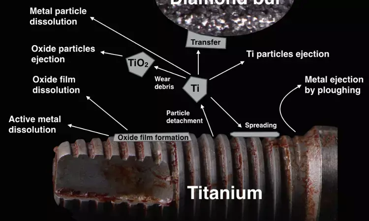 Commercially pure titanium debris  may induce carcinogenic effects on peri-implant tissues: Study