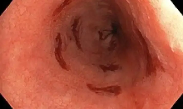 Endoscopic Bile Reflux Strongly Associated with Barretts Esophagus, finds study