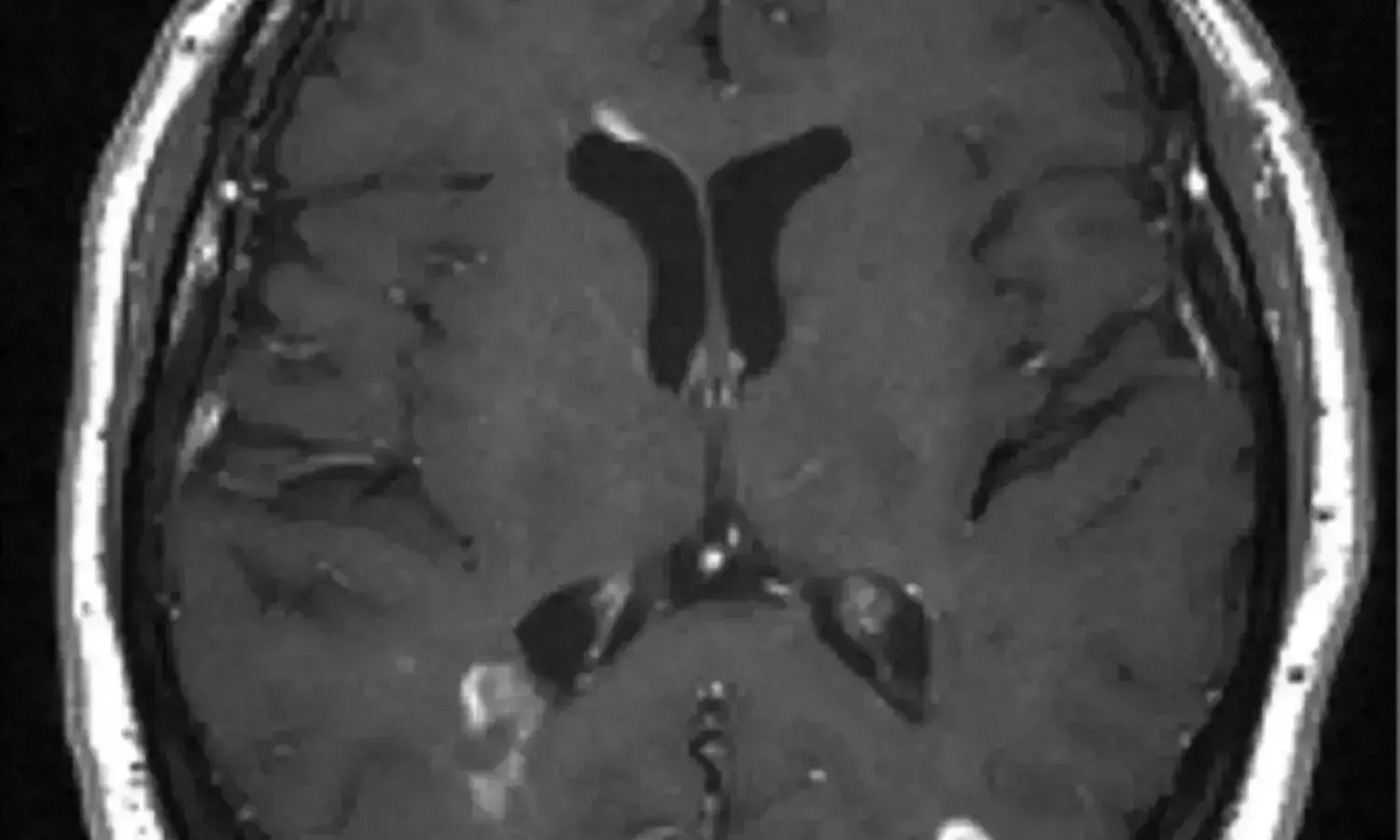 New MRI technique detects MS brain changes earlier