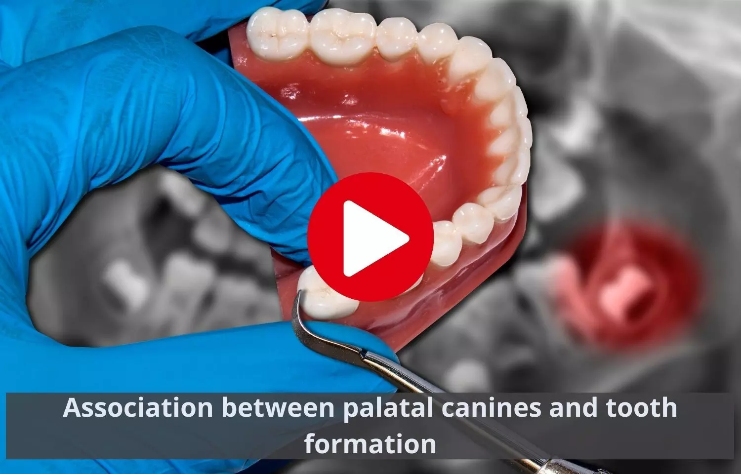 Unilateral Palatally displaced canines may not delay tooth formation