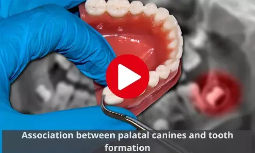 Unilateral Palatally displaced canines may not delay tooth formation