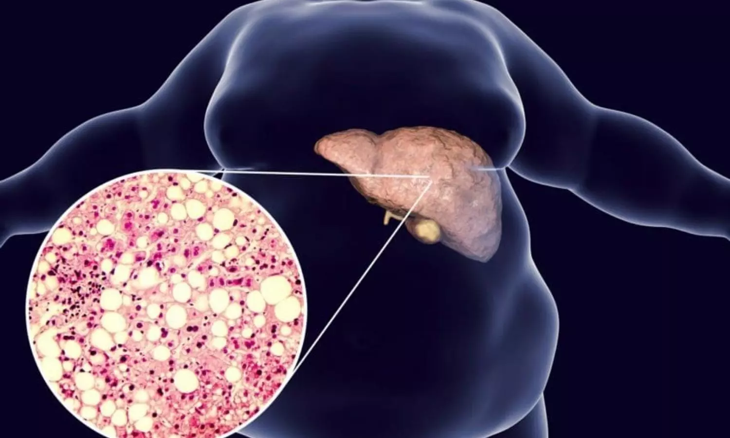 Metabolic dysfunction associated fatty liver disease tied to cancer risk: Study