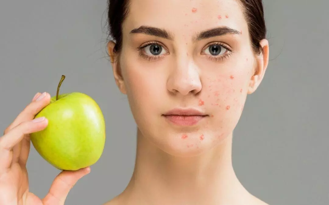 Battle Acne with Healthy Diet and Lifestyle