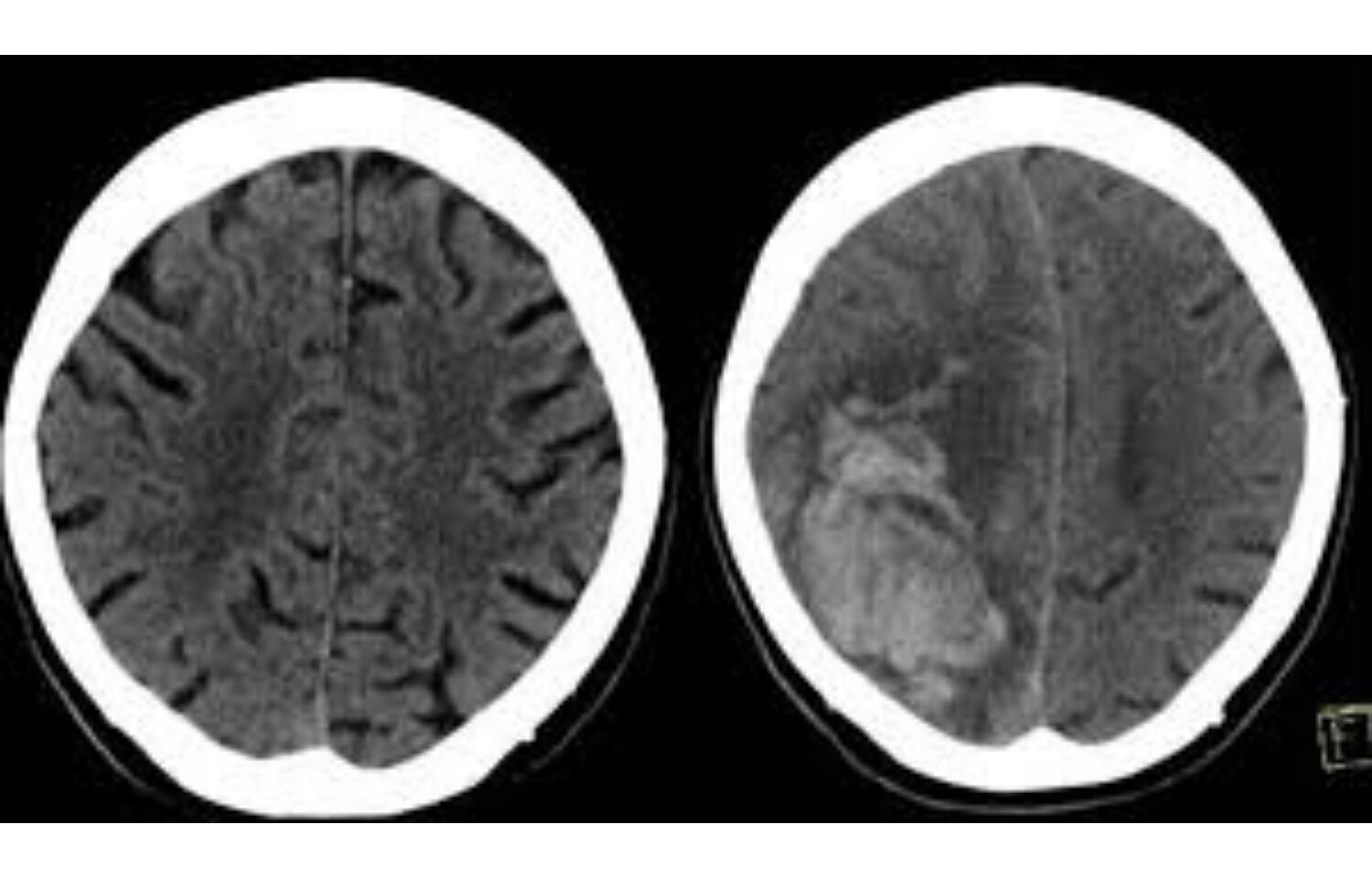 Popular blood thinners may lead to brain bleeding after head injury