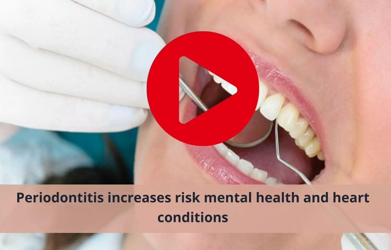 Risk of mental health and heart conditions higher with Periodontitis