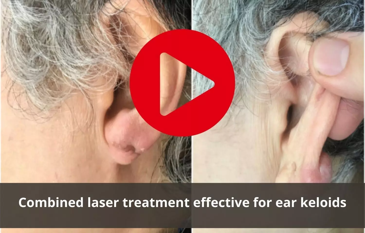 Ear keloids to be treated by combined lasers finds study