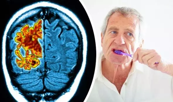 Maintaining Oral Health Might Benefits Alzheimers Patients