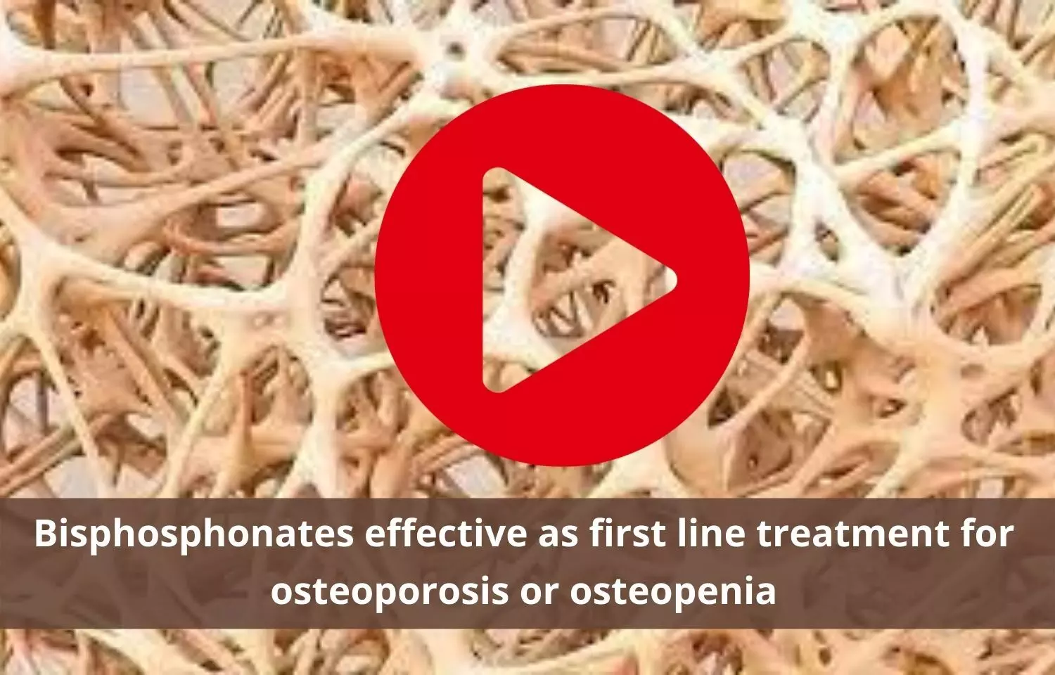 Bisphosphonates - the first line treatment for osteoporosis or osteopenia