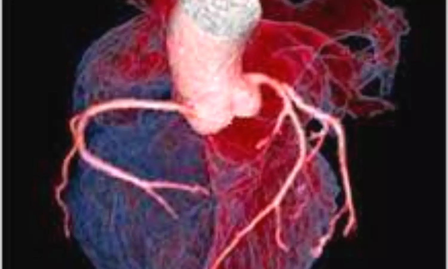 Noninvasive CT scan before coronary angiography improves satisfaction, outcomes in patients with prior CABG: BYPASS-CTCA