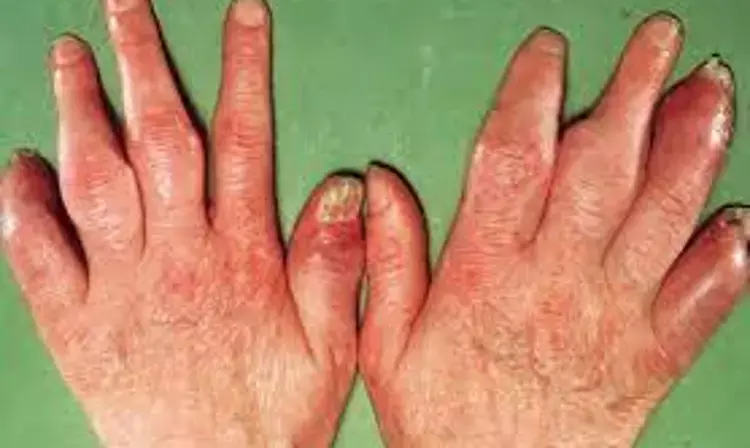 Dactylitis tied with higher disease burden in early psoriatic arthritis: BMJ