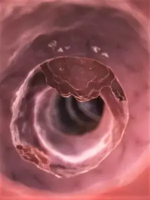 T2D Might Increase Risk of Post Colonoscopy Colorectal Cancer: BMC
