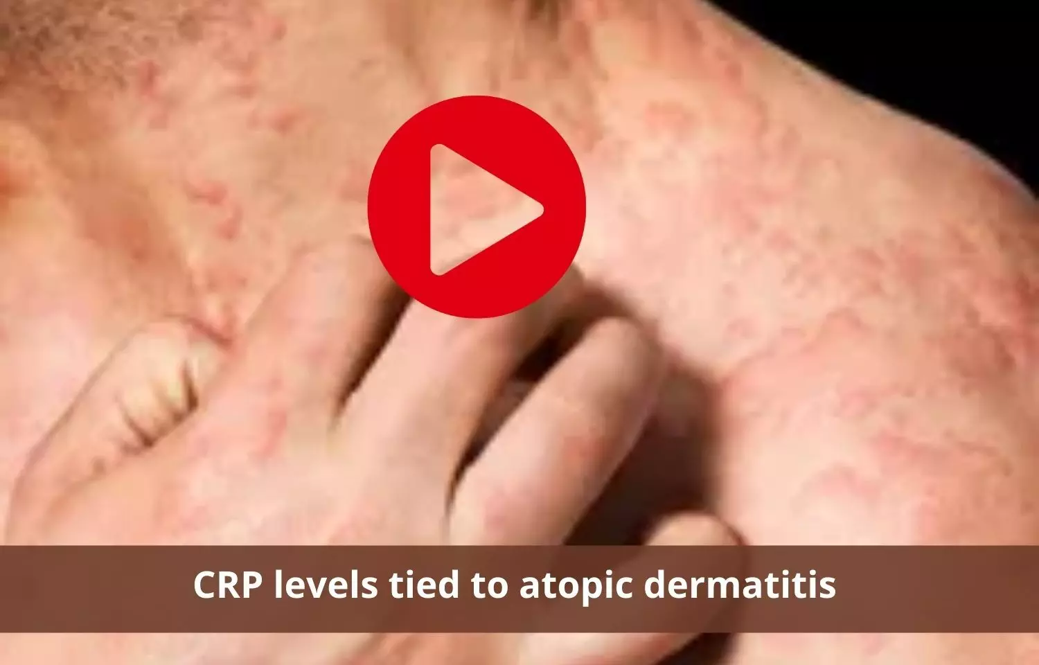 Atopic dermatitis to be related to higher levels of CRP