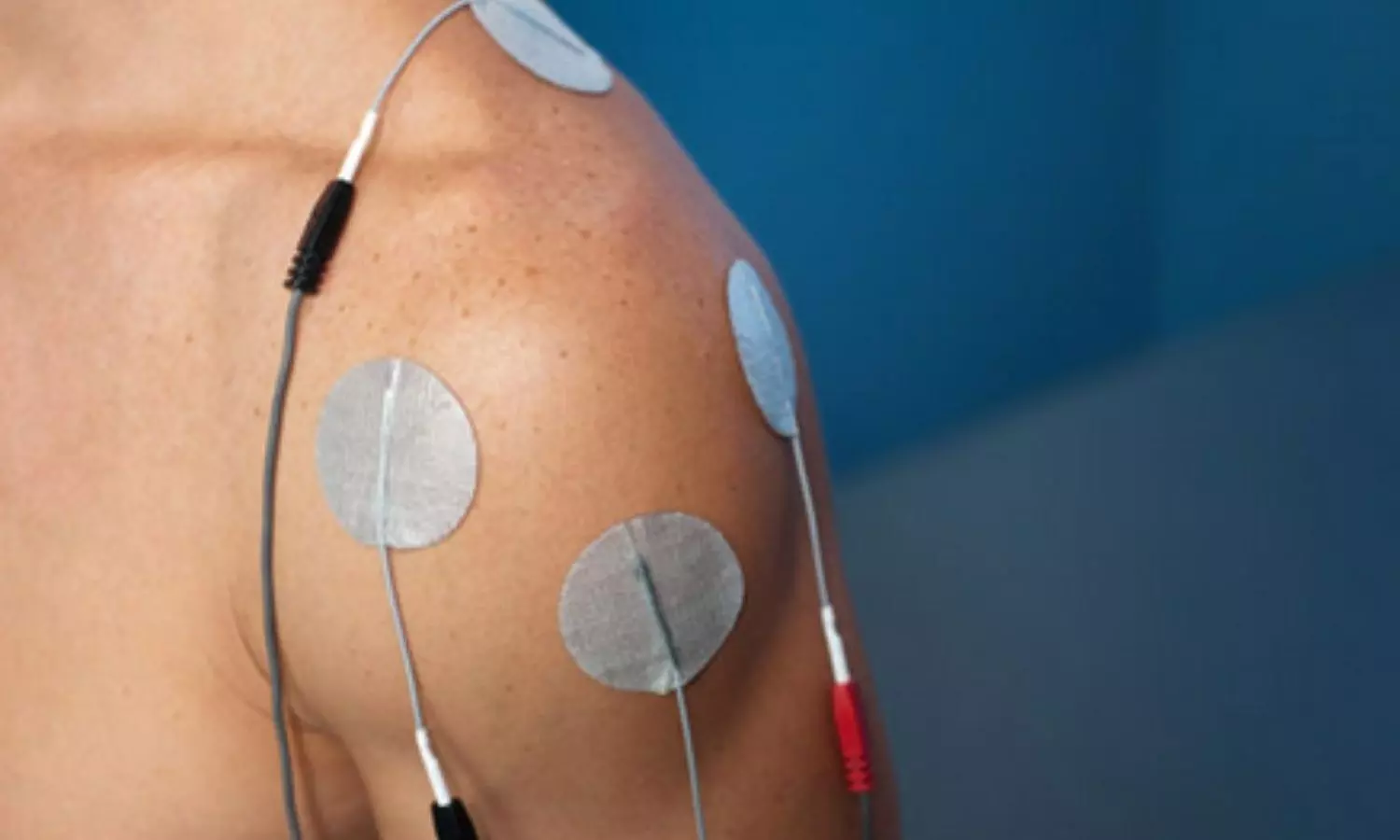 Electrical stimulation improves glucose tolerance in obese individuals: Study