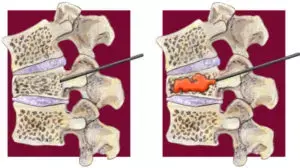 Cardiac Perforation Caused by Cement Embolism after Percutaneous Vertebroplasty: Two Cases reports