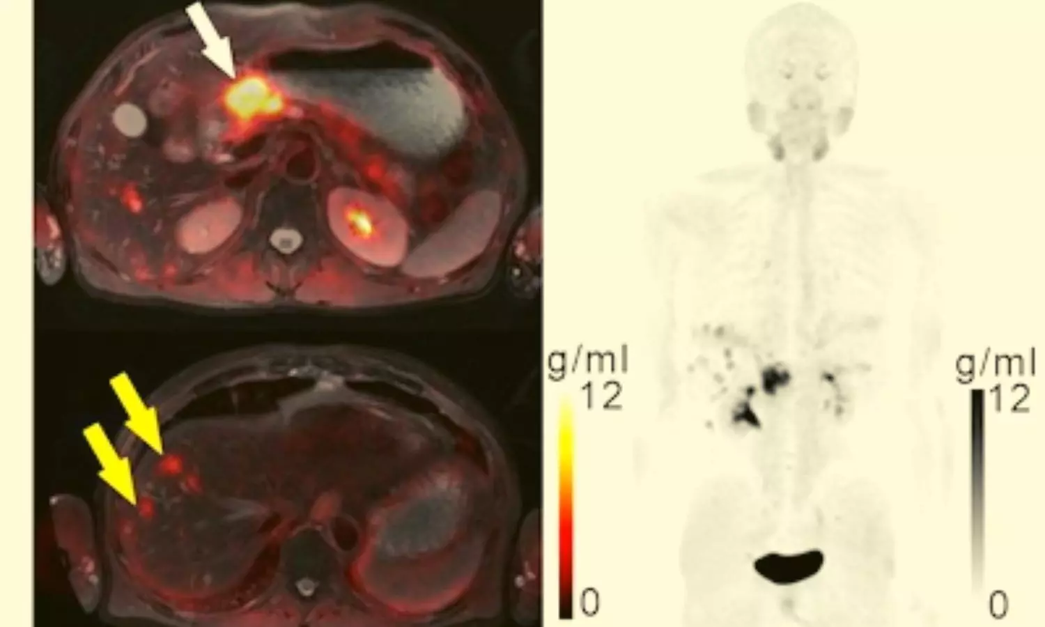 FAPI-PET better than standard molecular imaging for diagnosis of gastric cancer, study finds