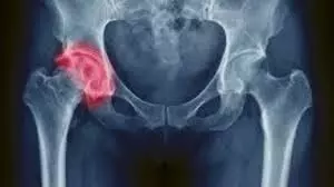 Drug holidays after long-term use of risedronate may not increase risk of hip fracture: study
