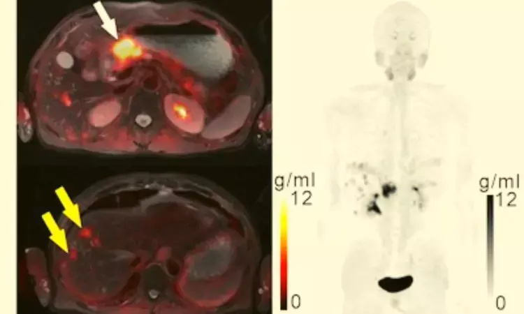 FAPI-PET better than standard molecular imaging for diagnosis of gastric cancer, study finds
