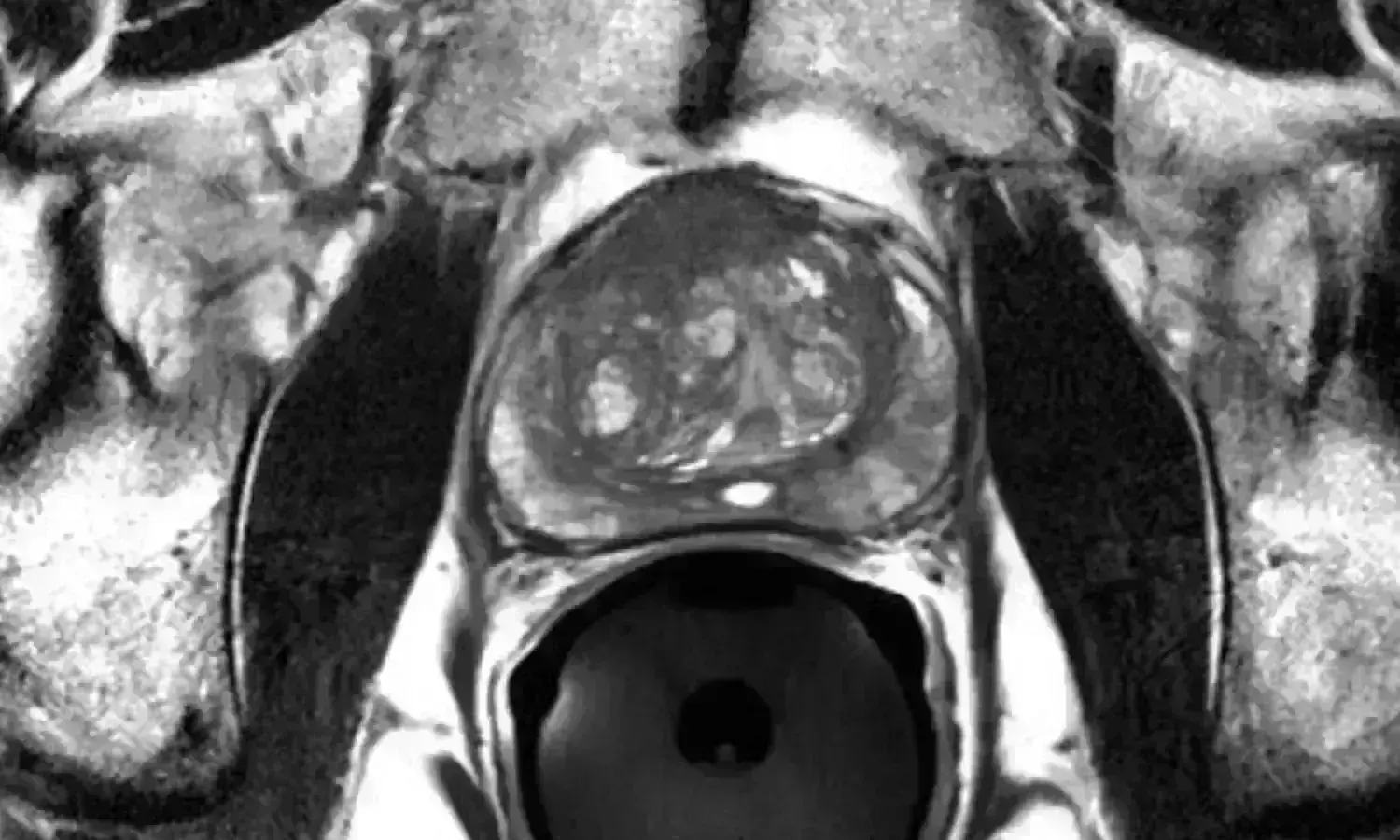 MRI-guided radiotherapy appears to lead to fewer side effects from treatment for prostate cancer