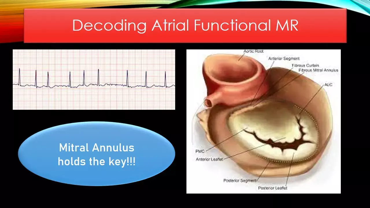Impaired mitral annulus dynamics are responsible for Atrial functional MR finds JACC study.