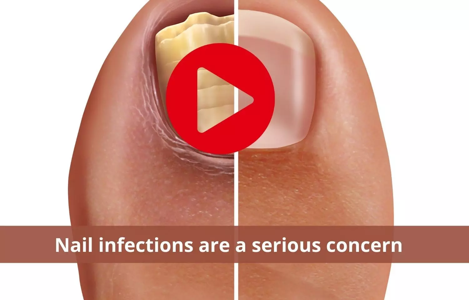 Nail infections need more attention, its a serious concern