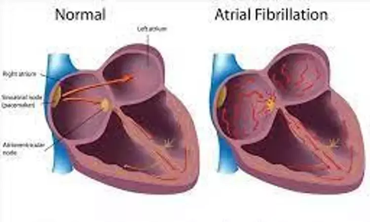 Still not enough evidence to recommend atrial fibrillation screening: USPSTF