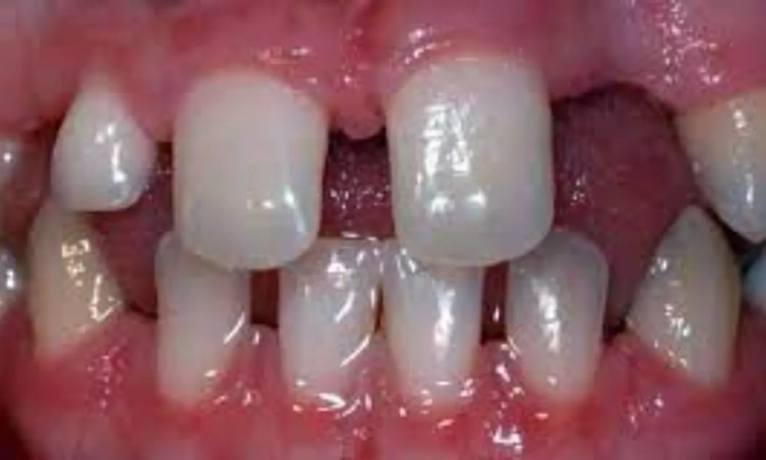 Space opening a favoured orthodontic approach for  hypodontia: Study