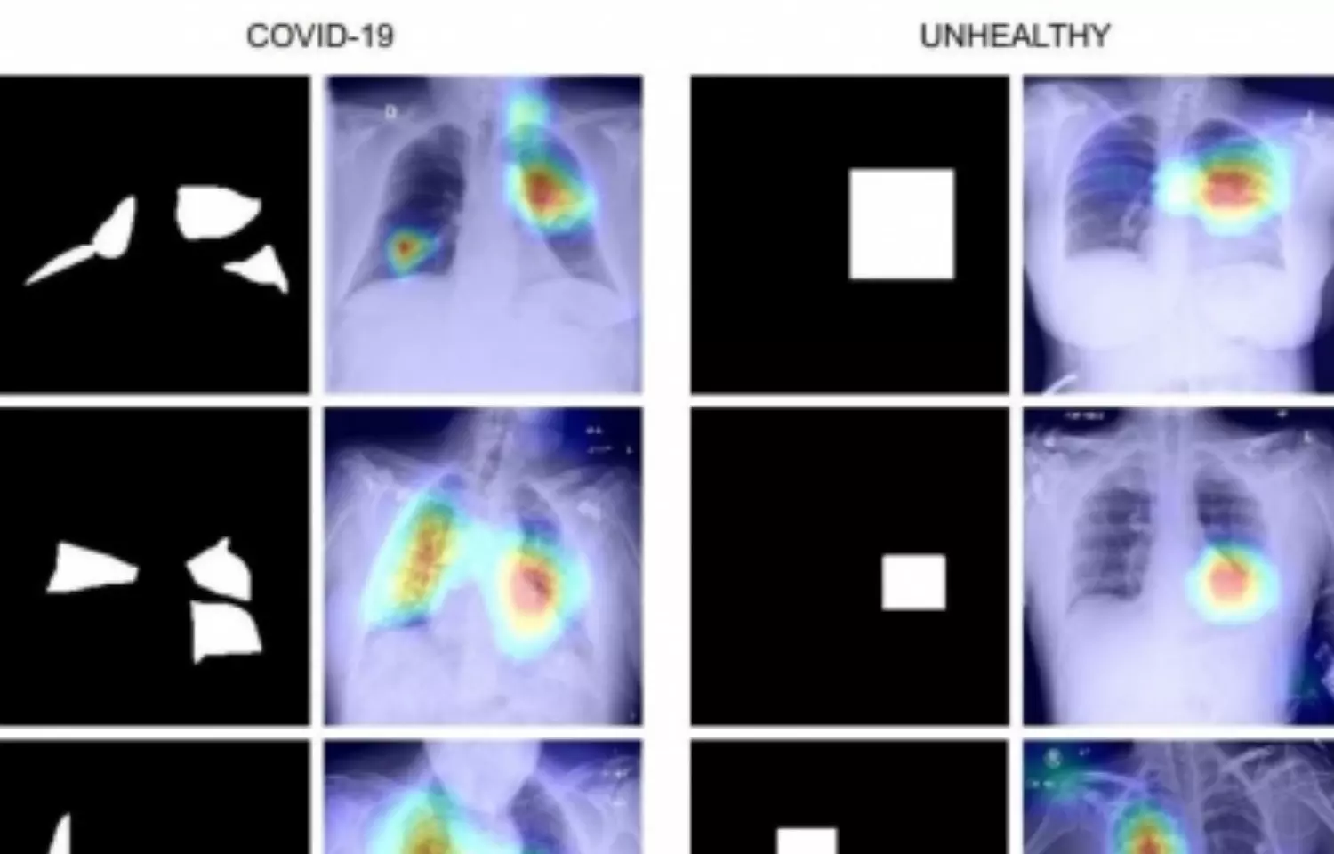 COVID diagnosis technique using chest X-Ray images developed by IIT Jodhpur