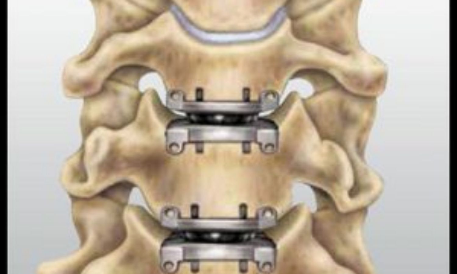 Pillow of Degenerative disc disease, 3D CT scan