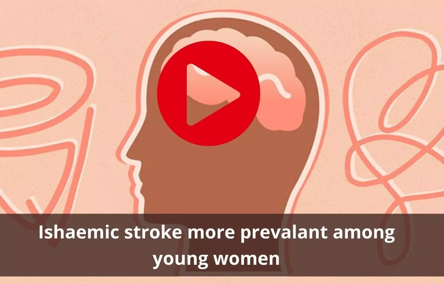 Ischemic stroke more prevalent in young women than men
