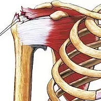Autograft Long Head Biceps Tendon Can Be Used as a Scaffold for Biologically Augmenting Rotator Cuff Repairs