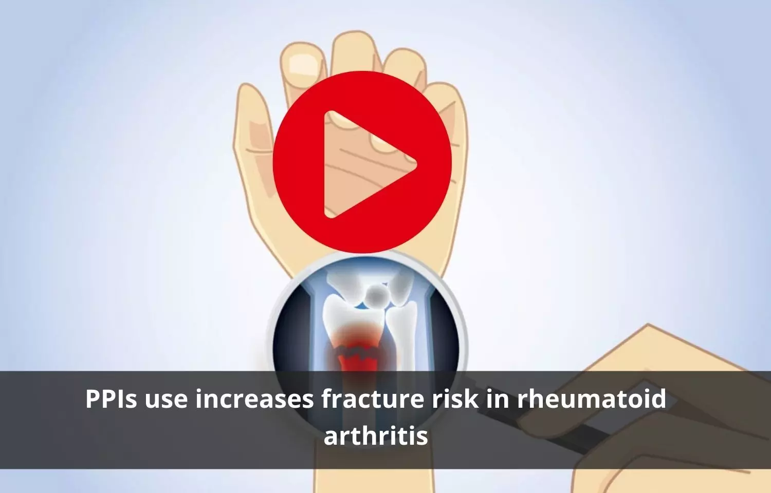 PPIs use to cause fracture risk in rheumatoid arthritis