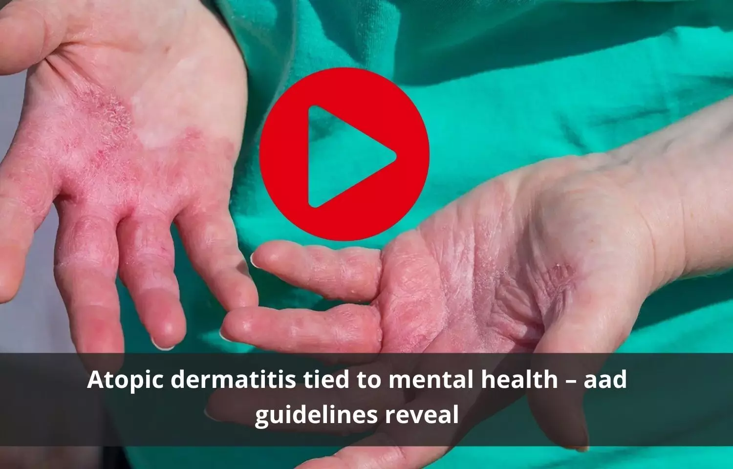 Atopic dermatitis associated to affect mental health