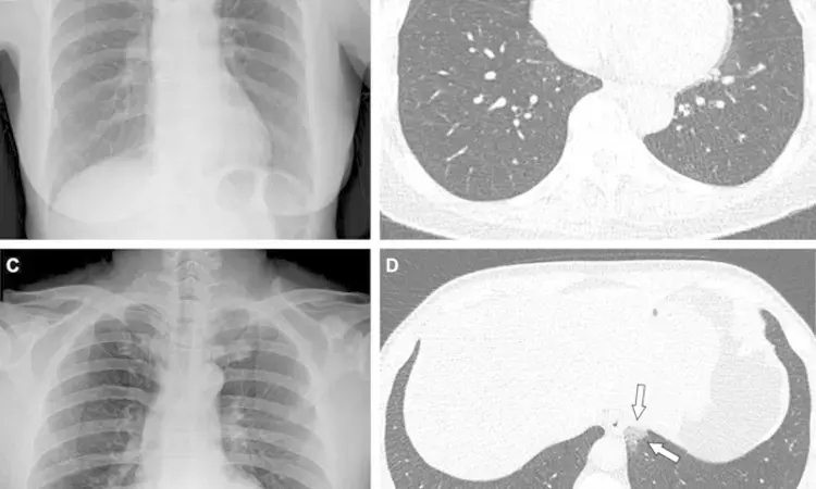 Covid-19 less severe in vaccinated, confirm radiological findings