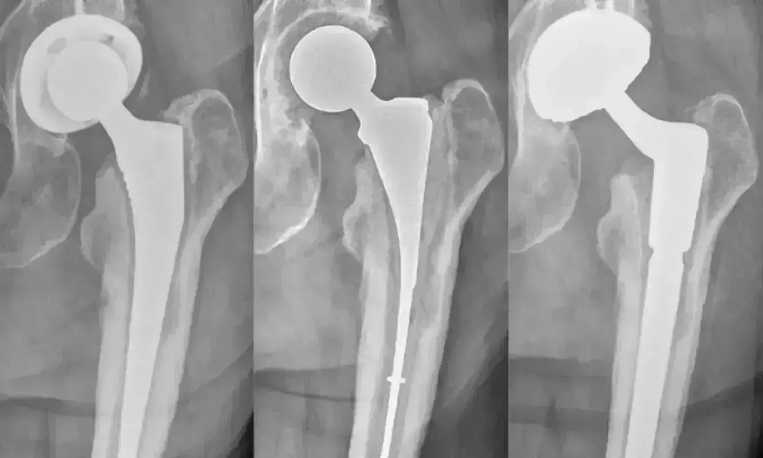 Perioperative periprosthetic joint infection prevention in total hip and knee replacement: European consensus