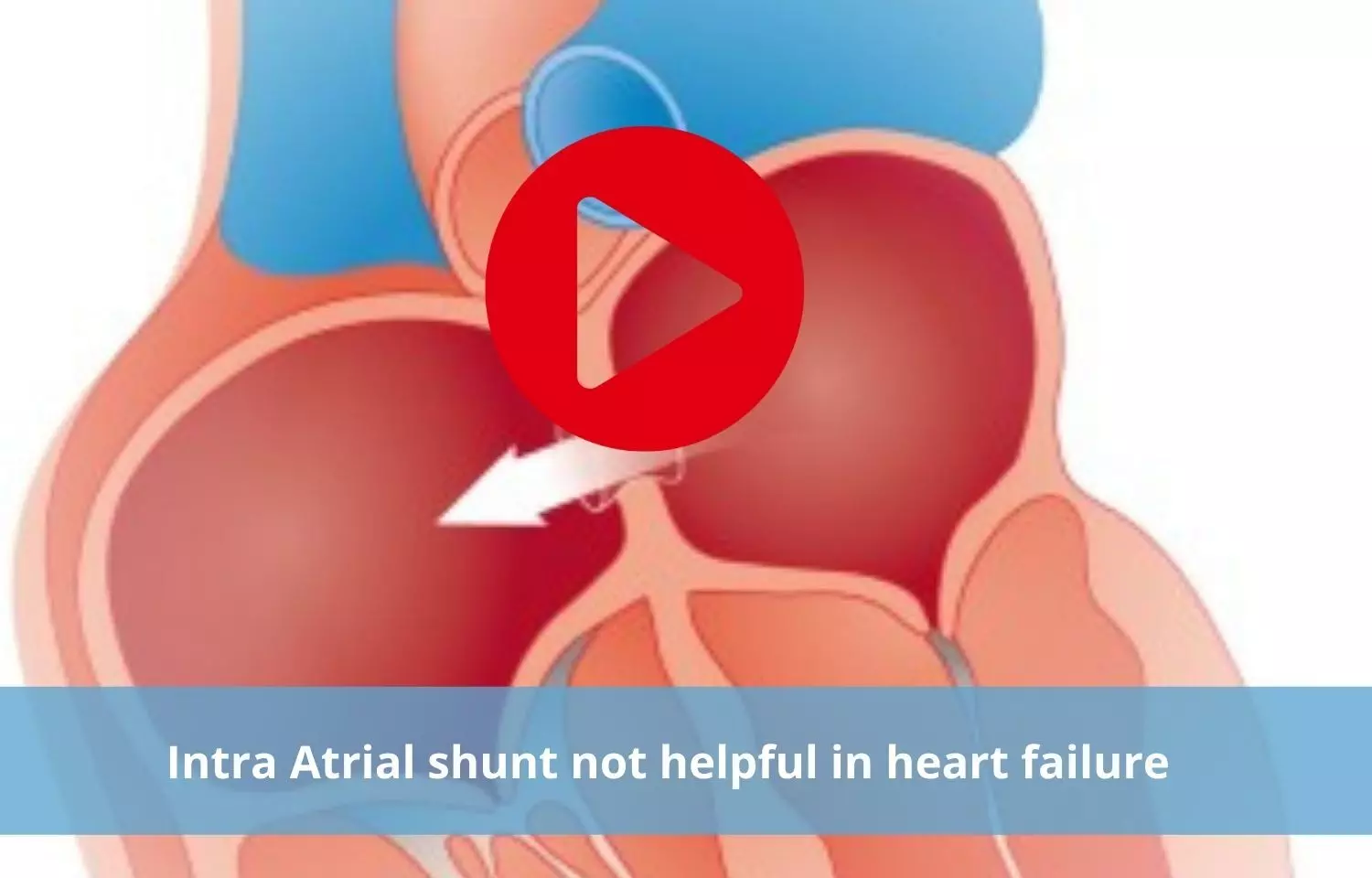 Intra Atrial shunt is inefficient in preventing heart failure