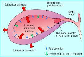 Continuing Antithrombic therapy safe during emergency lap chole for ...