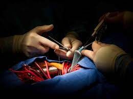 Repairing Tricuspid valve During MV Surgery prevents Tricuspid Regurgitation progression