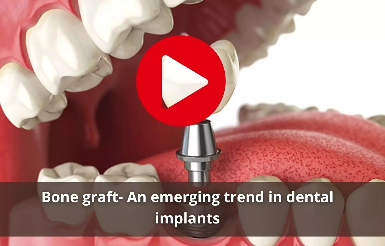 Bone graft-   A face changing trend in dental implants