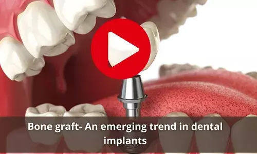 Bone graft-   A face changing trend in dental implants