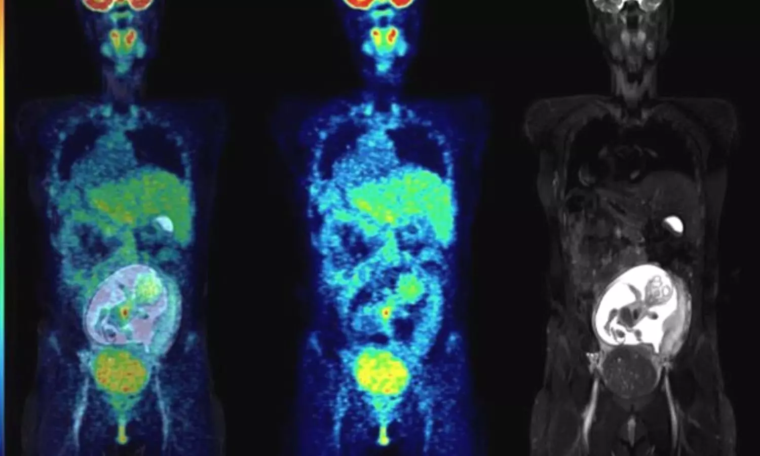 Hybrid PET/MRI scans safe in pregnant women with cancer, study finds