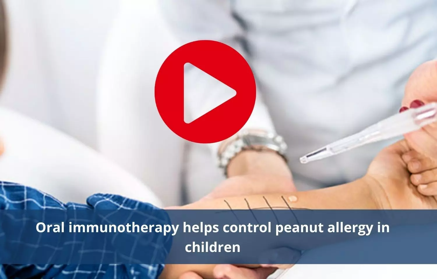 Oral immunotherapy effective in controlling peanut allergy in children