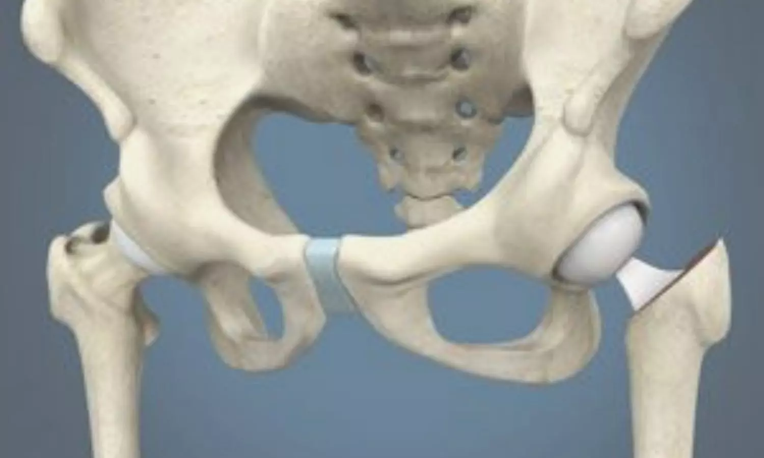 Cemented hemiarthroplasty tied to better quality of life in elderly with intracapsular hip fracture: NEJM