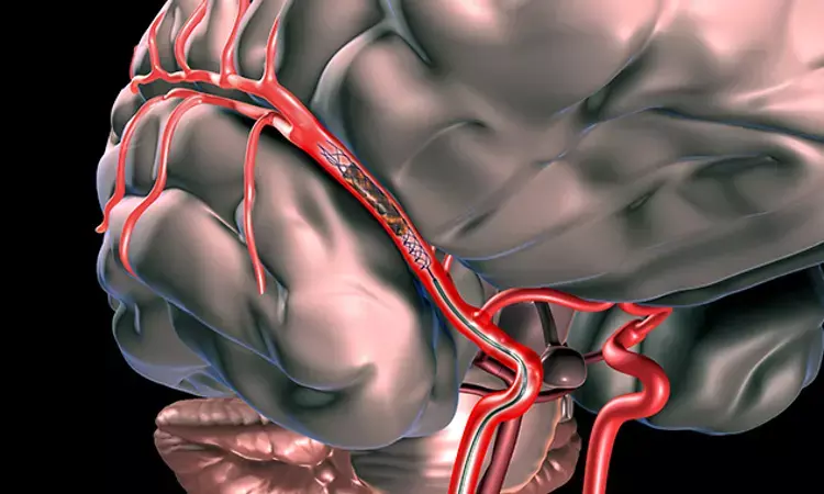 Endovascular Therapy Might Benefit Stroke Patients with Large Ischemic Region