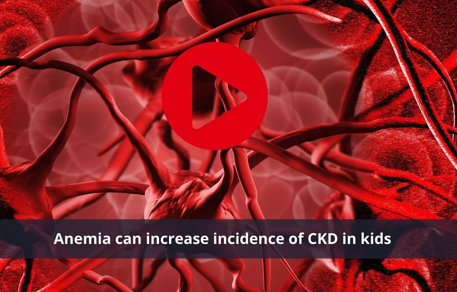 Anemia a risk factor of Chronic Kidney Disease in kids