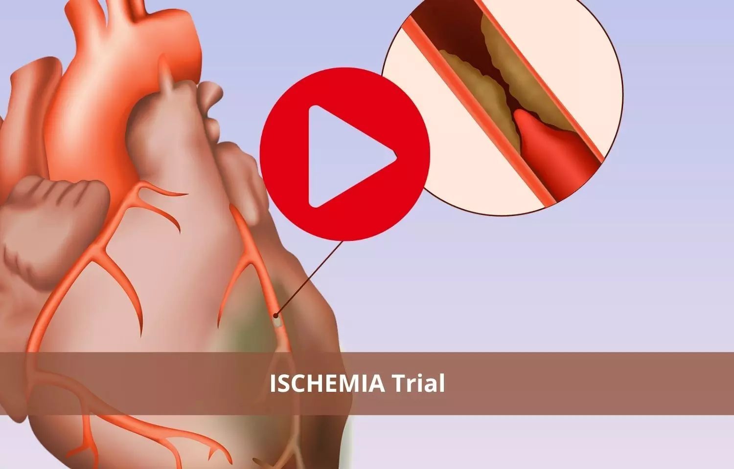 ISCHEMIA Trial: Routine invasive therapy does not reduce MACE