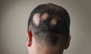 Study: Not all Alopecia Areata Patients Might Suffer Vitamin D Deficiency
